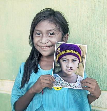 Lexxi, an eight-year-old Operation Smile patient from Colombia, beams with her new smile while holding an earlier photo of herself. Prior to her surgery, Lexxi had difficulty eating and breathing, and was bullied at school.(Photo provided)