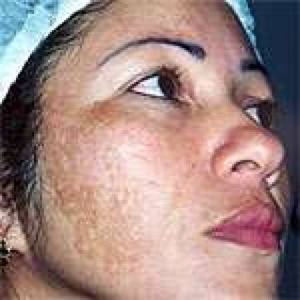 Creams can alleviate 'mask of pregnancy' Creams can alleviate 'mask of pregnancy'